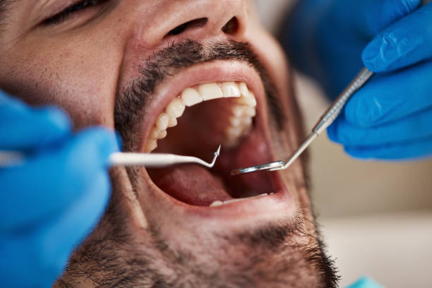Best Emergency Root Canal Treatment in Sidney, OH